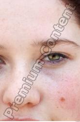 Eye Woman White Birthmarks Average